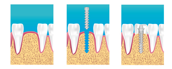 implant dentaire marseille 13010
